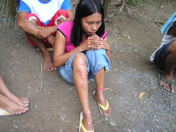 leg injury...