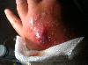 Federal terrorism USA? Handshake germ warfare