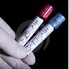 HIV-Negative AIDS: is it CFIDS or AIDS?